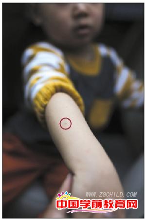 昨日，古城民族幼儿园小班的一名孩童展示被扎后留下的针眼(图中红圈处)。