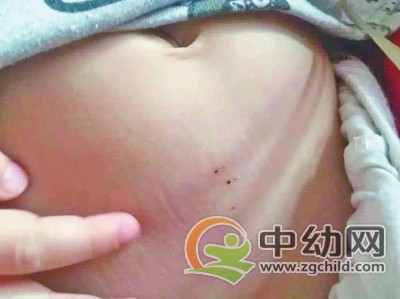 孩子身上疑似被针扎后留下的伤痕